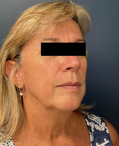 Facelift case #11190
