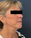 Facelift case #11190
