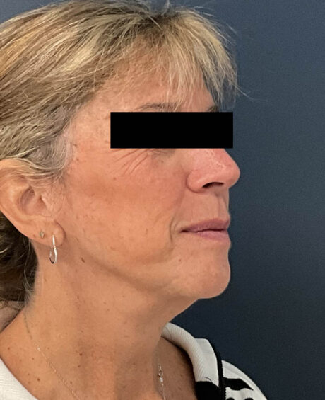 Facelift case #11190