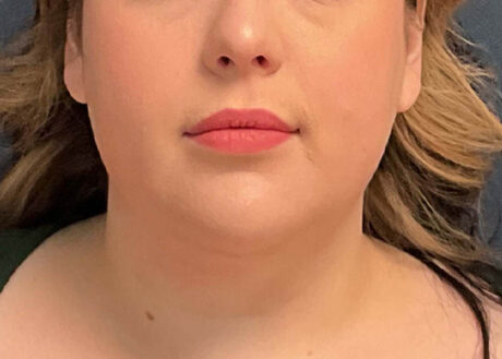 Chin Liposuction case #11253