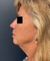 Facelift case #11190