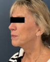 Facelift case #11190