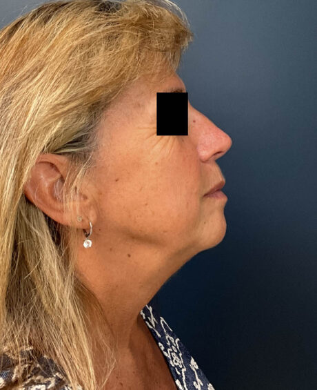 Facelift case #11190