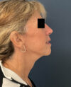 Facelift case #11190