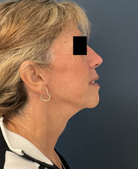 Facelift case #11190