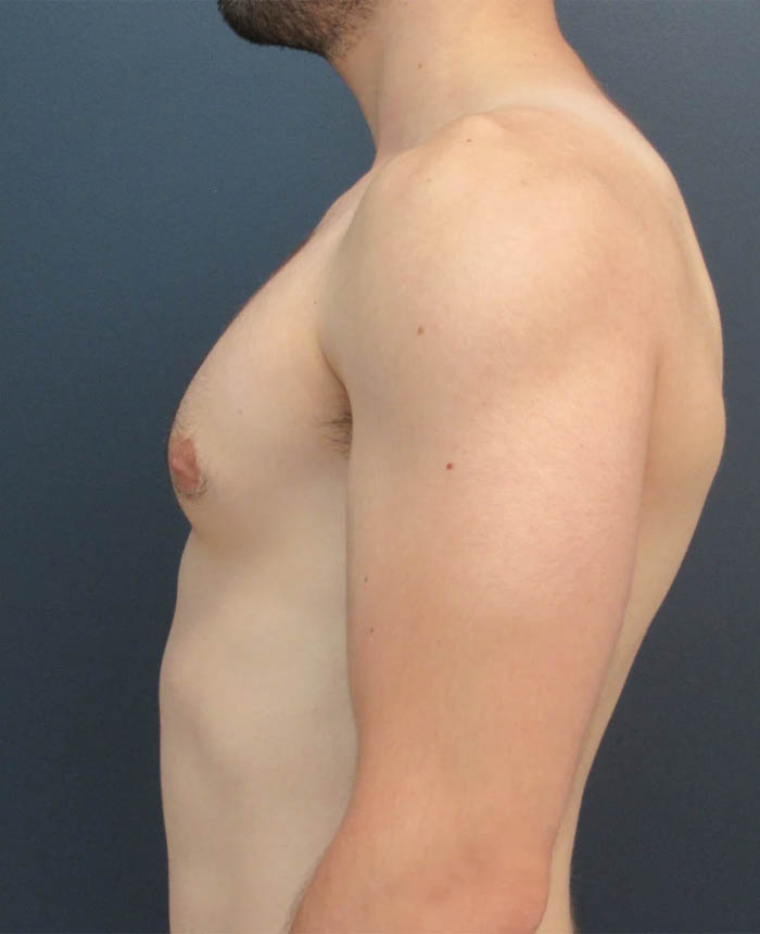Gynecomastia case #11423
