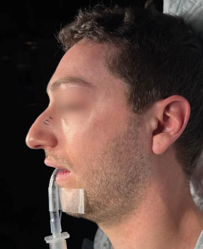 Rhinoplasty case #11402