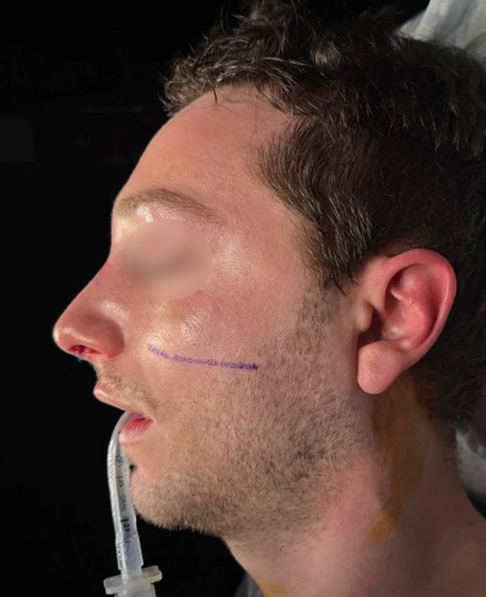 Rhinoplasty case #11402