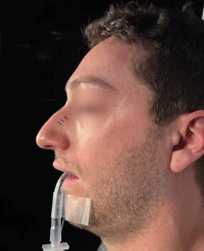 Rhinoplasty case #11402