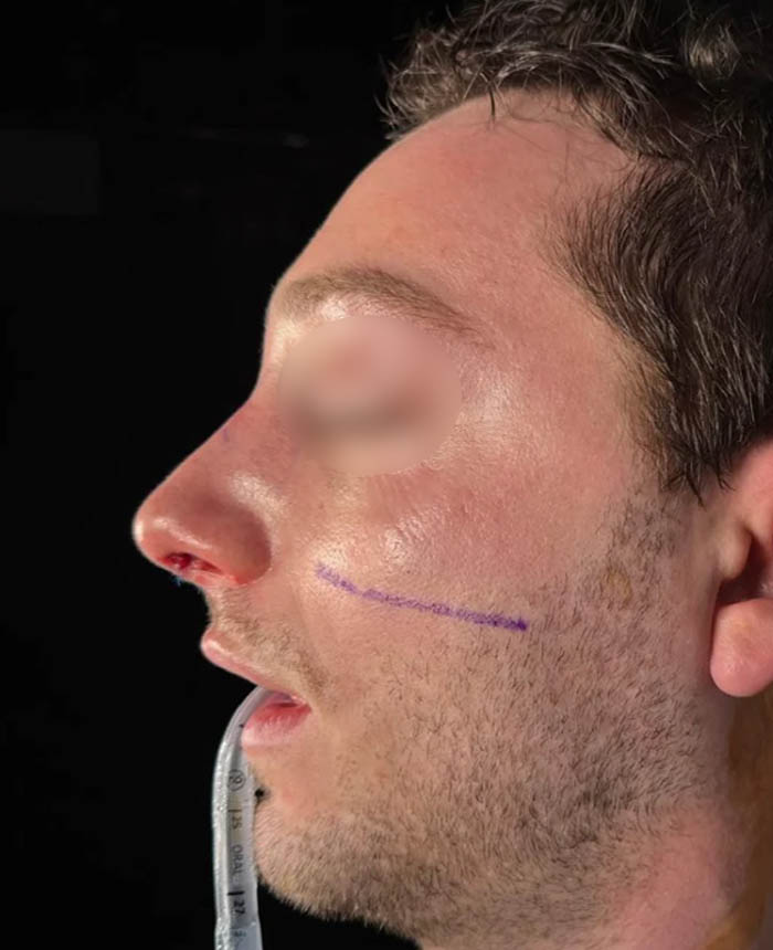 Rhinoplasty case #11402