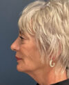Mini-Facelift case #11546