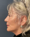 Mini-Facelift case #11546