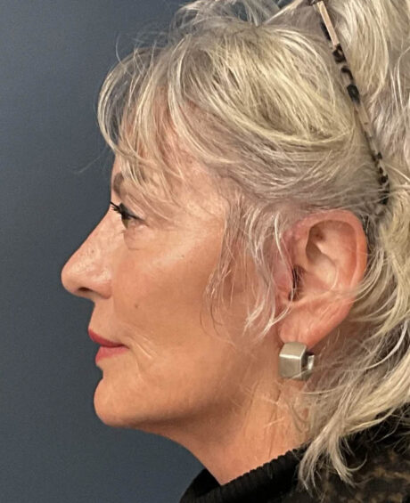 Mini-Facelift case #11546