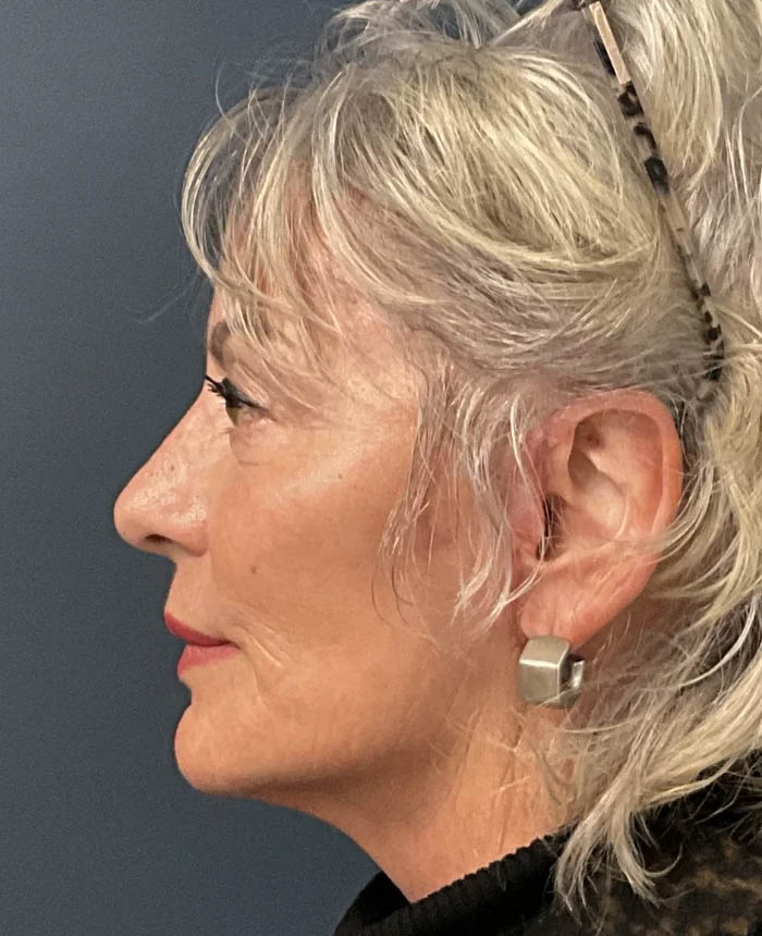 Mini-Facelift case #11546