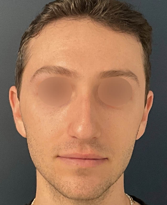 Rhinoplasty case #11402
