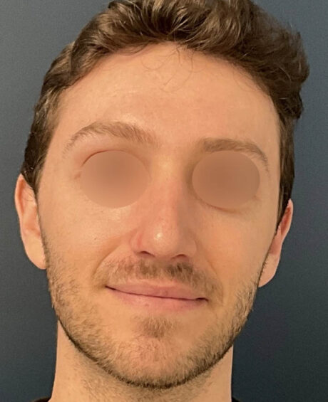 Rhinoplasty case #11402