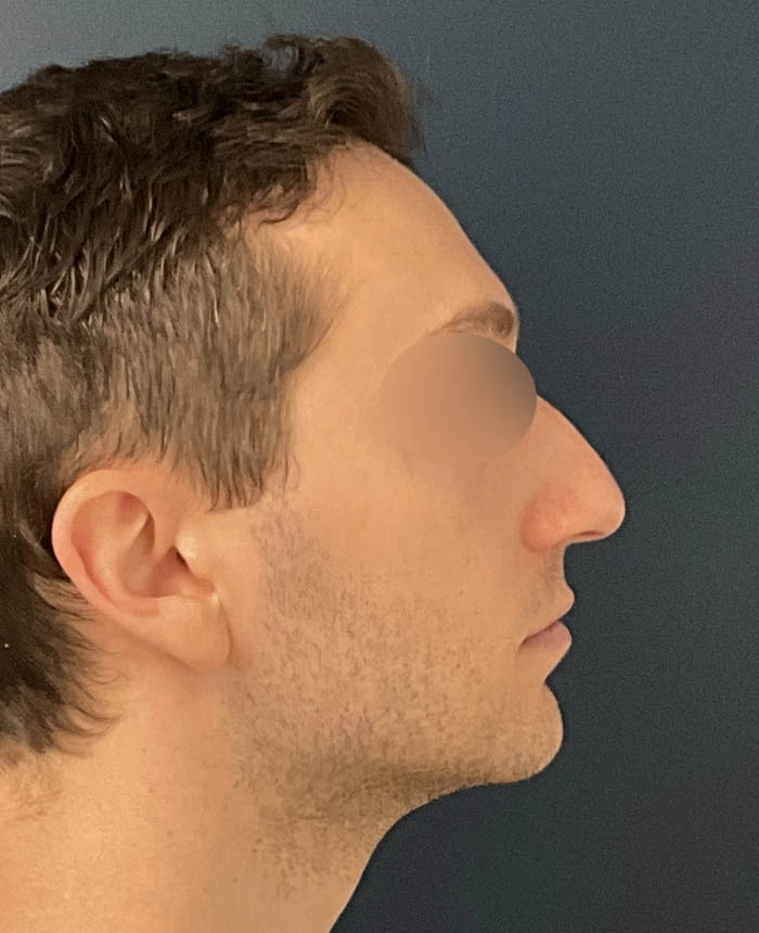 Rhinoplasty case #11402