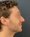 Rhinoplasty case #11402