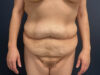 Tummy Tuck case #12030