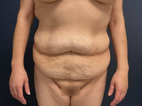 Tummy Tuck case #12030