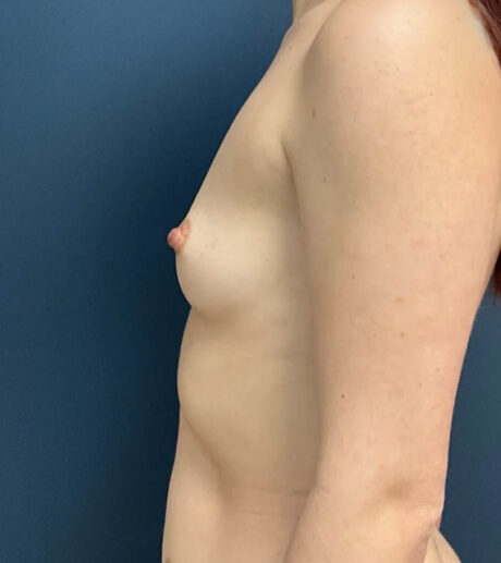 Breast Augmentation case #12012