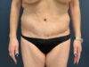 Tummy Tuck case #12030