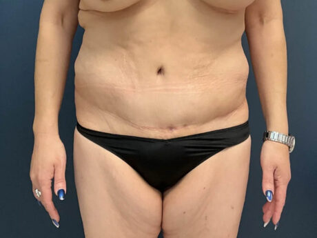 Tummy Tuck case #12030