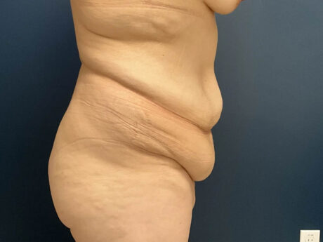 Tummy Tuck case #12030