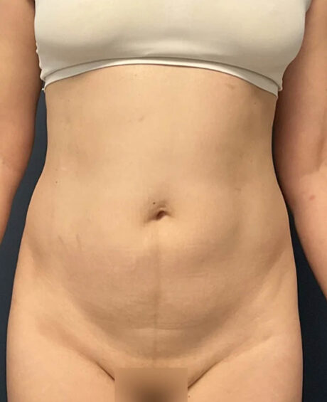 Liposuction case #12002