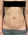 Liposuction case #12002