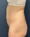 Liposuction case #12002