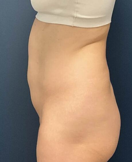 Liposuction case #12002