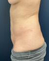 Liposuction case #12002