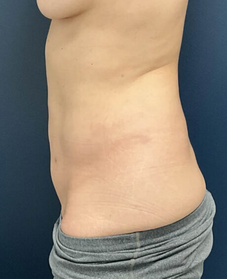 Liposuction case #12002