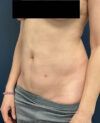 Liposuction case #12002
