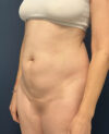 Liposuction case #12002