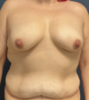 Breast Augmentation case #12020