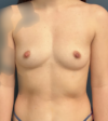 Breast Augmentation case #12012