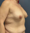 Breast Augmentation case #12020