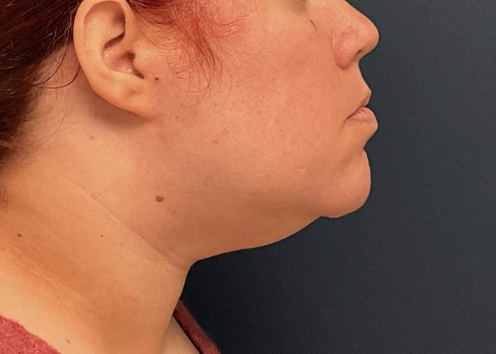 Chin Liposuction case #12545