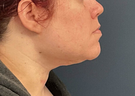 Chin Liposuction case #12545
