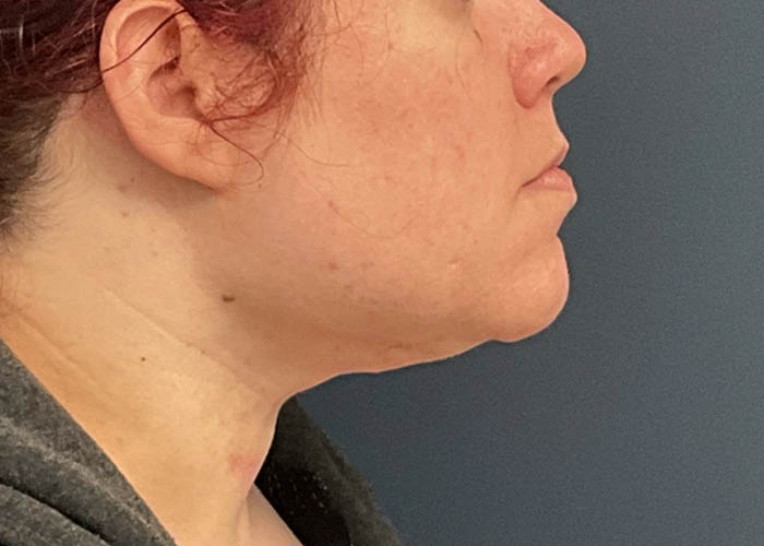 Chin Liposuction case #12545