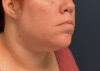 Chin Liposuction case #12545