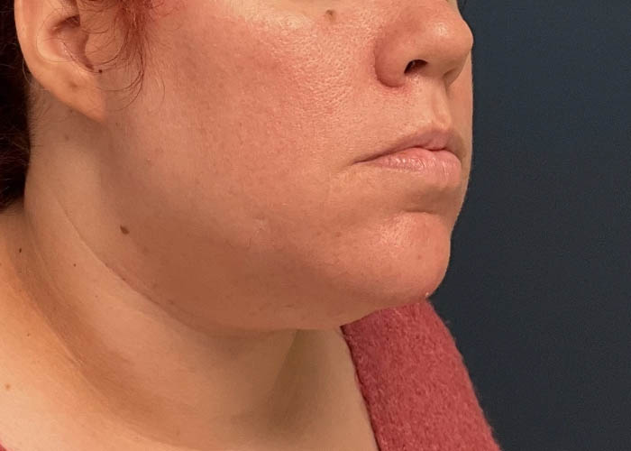 Chin Liposuction case #12545
