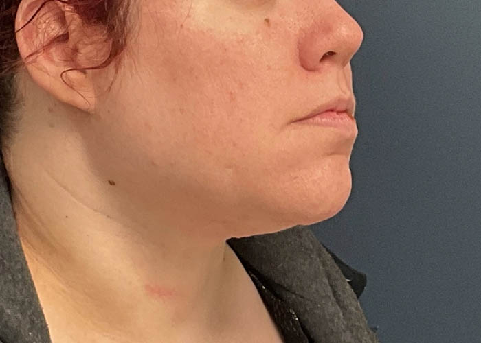 Chin Liposuction case #12545