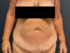 After Weight Loss case #13259