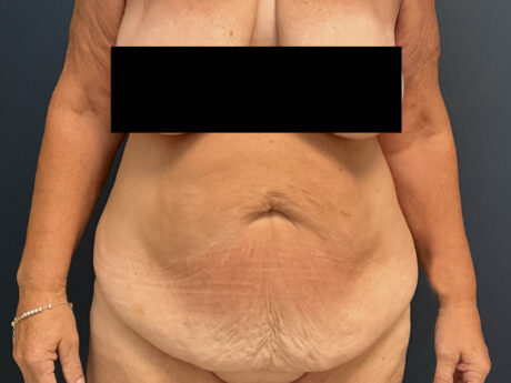 After Weight Loss case #13259