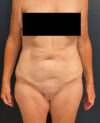 Lower Body Lift case #13252