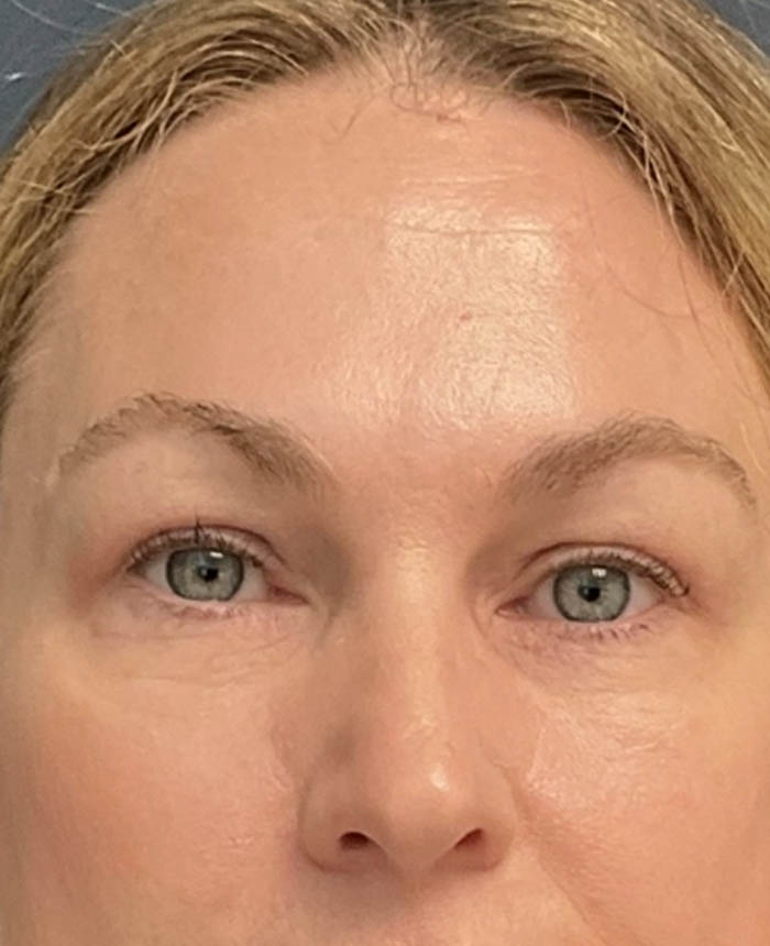 Eyelid Surgery case #12923