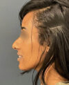 Rhinoplasty case #12940